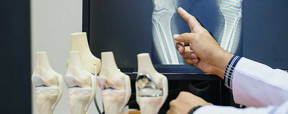 mr soong chua knee surgen melbourne - pointing at knee Xrays